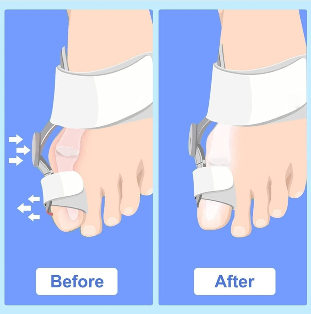 Corrector de juanetes