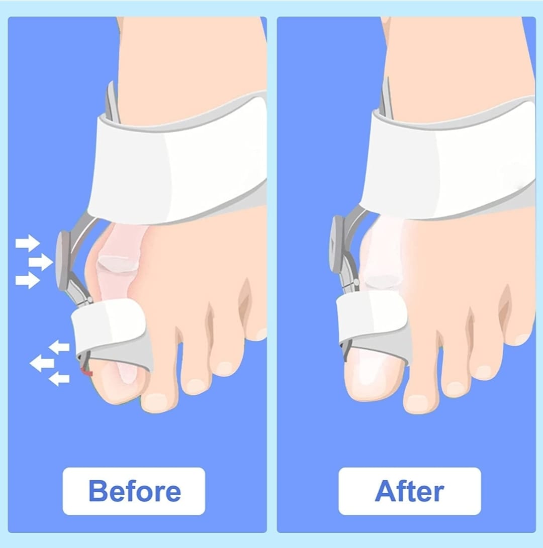 Corrector de juanetes